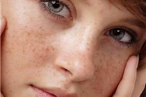 Những cách điều trị nám da mặt tại nhà Những cách điều trị nám da mặt tại nhà