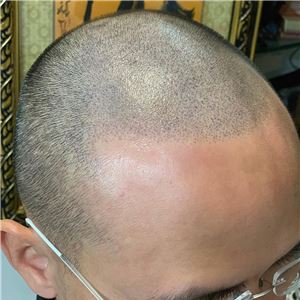XĂM CHẠM HẠT CHÂN TÓC CHE CHAN TÓC HÓI XĂM CHẠM HẠT CHÂN TÓC CHE CHAN TÓC HÓI