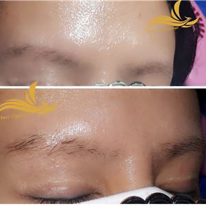 Xóa xăm nhanh chóng, đơn giản và nhẹ nhàng Xóa xăm nhanh chóng, đơn giản và nhẹ nhàng