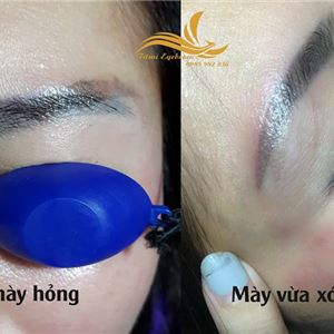Xóa xăm chân mày, mí mắt trổ xanh, đỏ an toàn và hiệu quả tại Hà Nội Xóa xăm chân mày, mí mắt trổ xanh, đỏ an toàn và hiệu quả tại Hà Nội