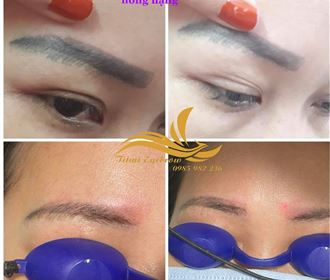 Liệu trình xóa chân mày cũ hỏng bằng lazer  Liệu trình xóa chân mày cũ hỏng bằng lazer